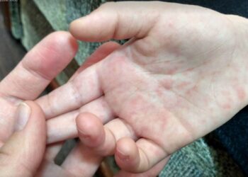 Қазақстанда балалар қызылшамен ауыра бастады