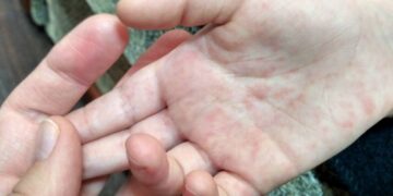 Қазақстанда балалар қызылшамен ауыра бастады