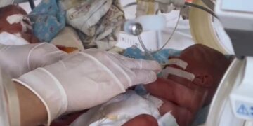 Дәрігерлер 850 грамм болып туған нәрестені аман алып қалды