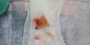 Дәрігерлер өңешіне сүйек қадалған әйелді құтқарды