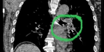 Дәрігерлер науқас өмірін сақтап қалды