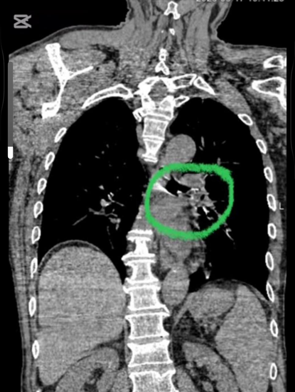 Дәрігерлер науқас өмірін сақтап қалды