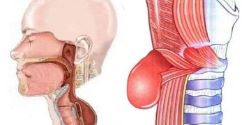 Алматы облысында өңештің сирек патологиясына шалдыққан науқасқа сәтті ота жасалды
